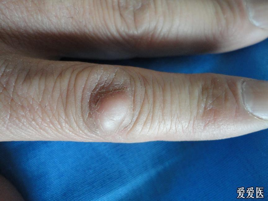 手指关节脂肪瘤图片图片
