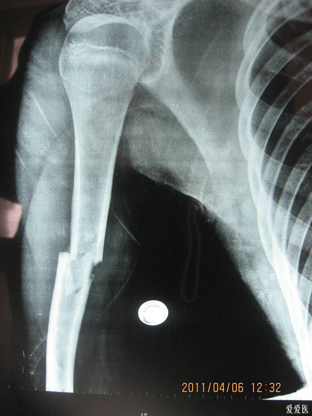 16岁男性肱骨骨折需要植骨吗