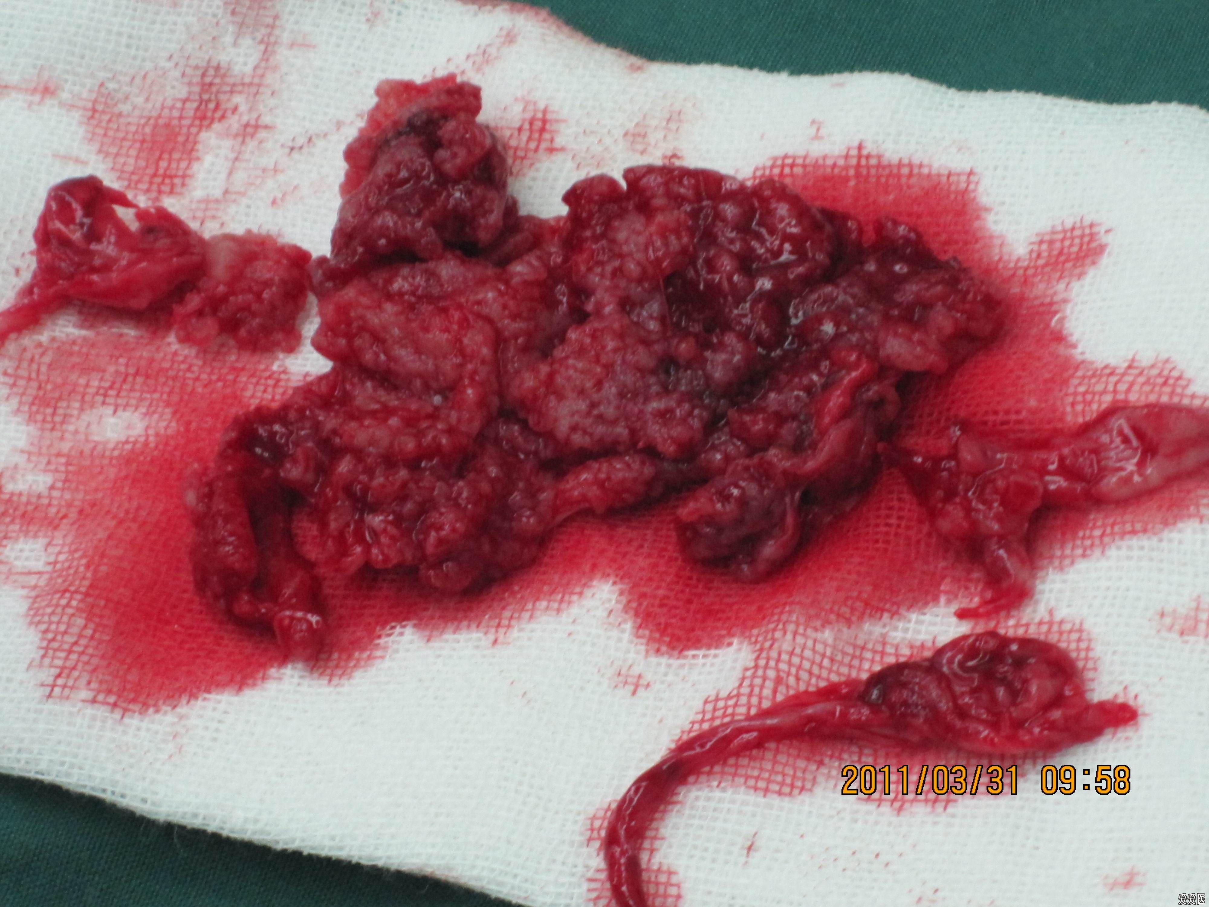 201111恶性多形性腺瘤已公布答案