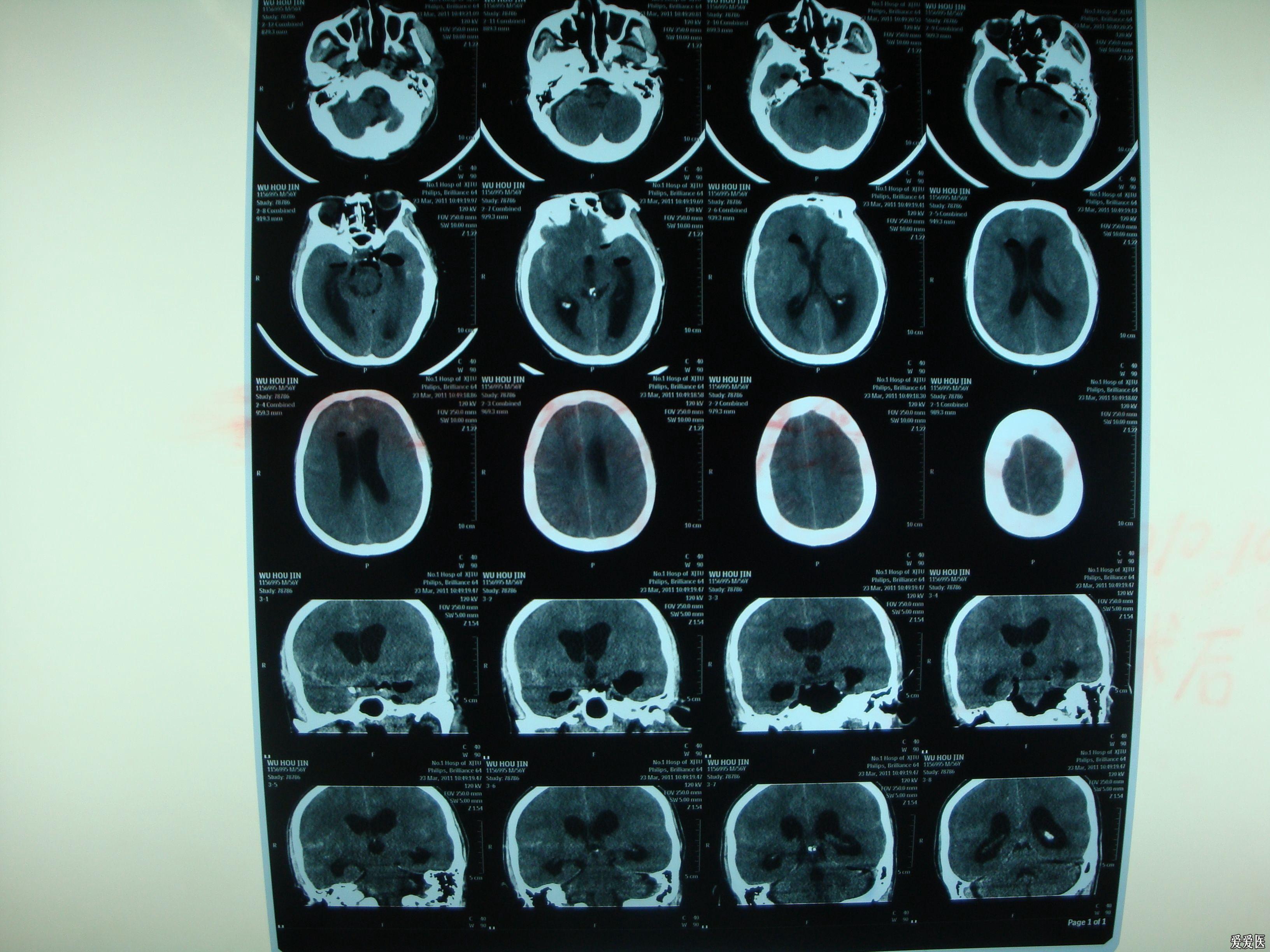 蛛网膜下腔出血MRI图片
