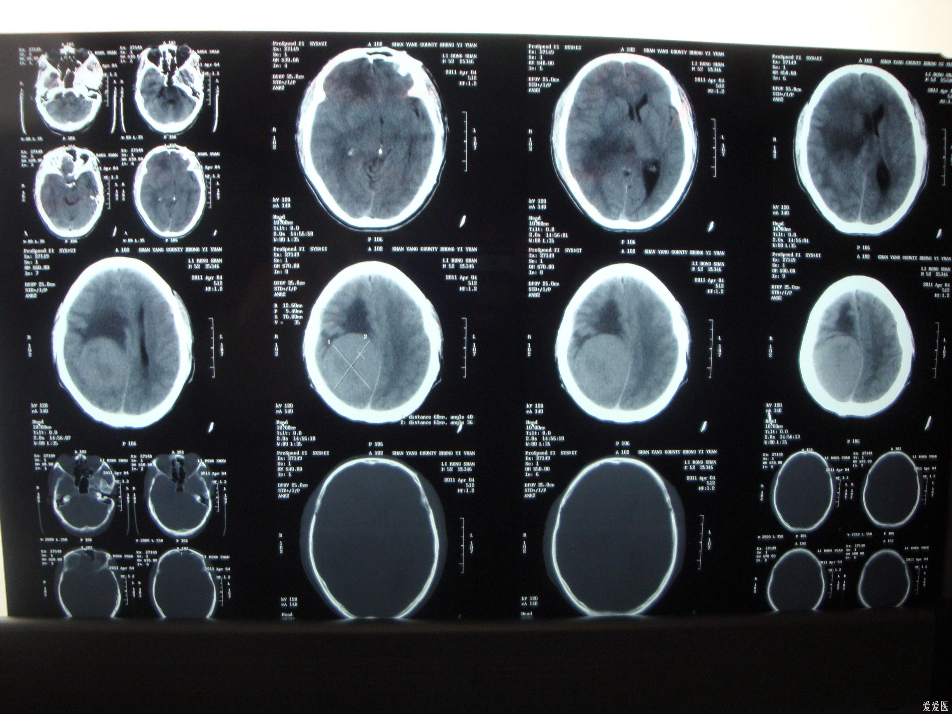 脑瘤x光图片图片