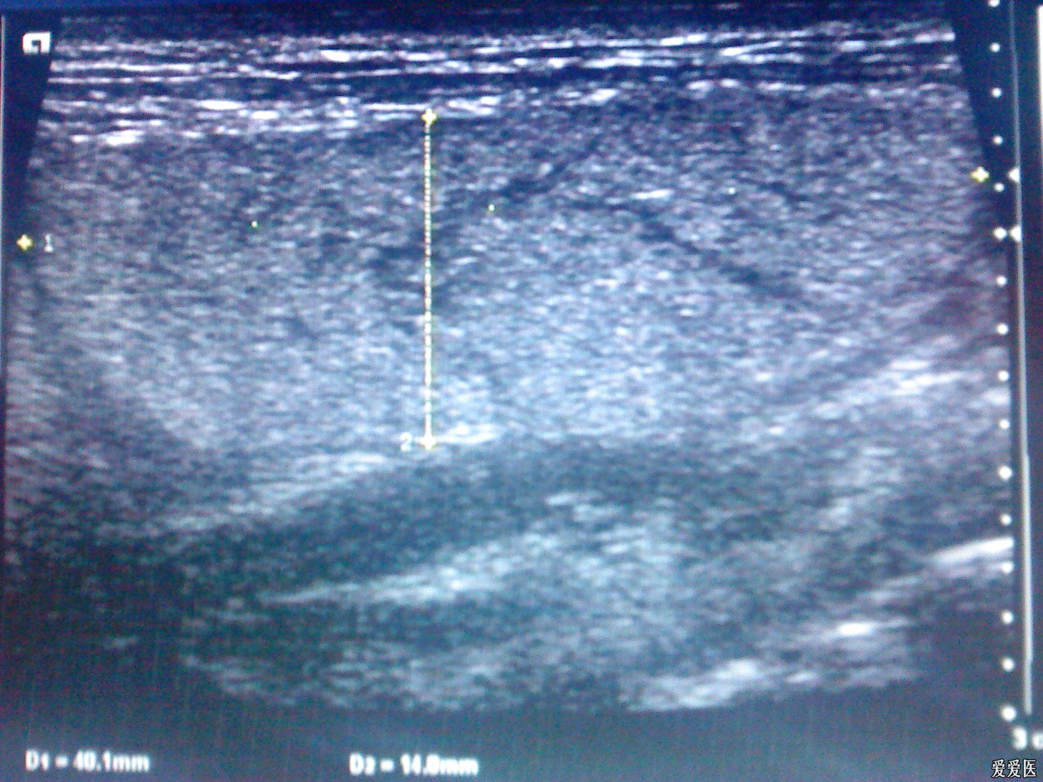 颌下腺炎? - 超声医学讨论版 - 爱爱医医学论坛