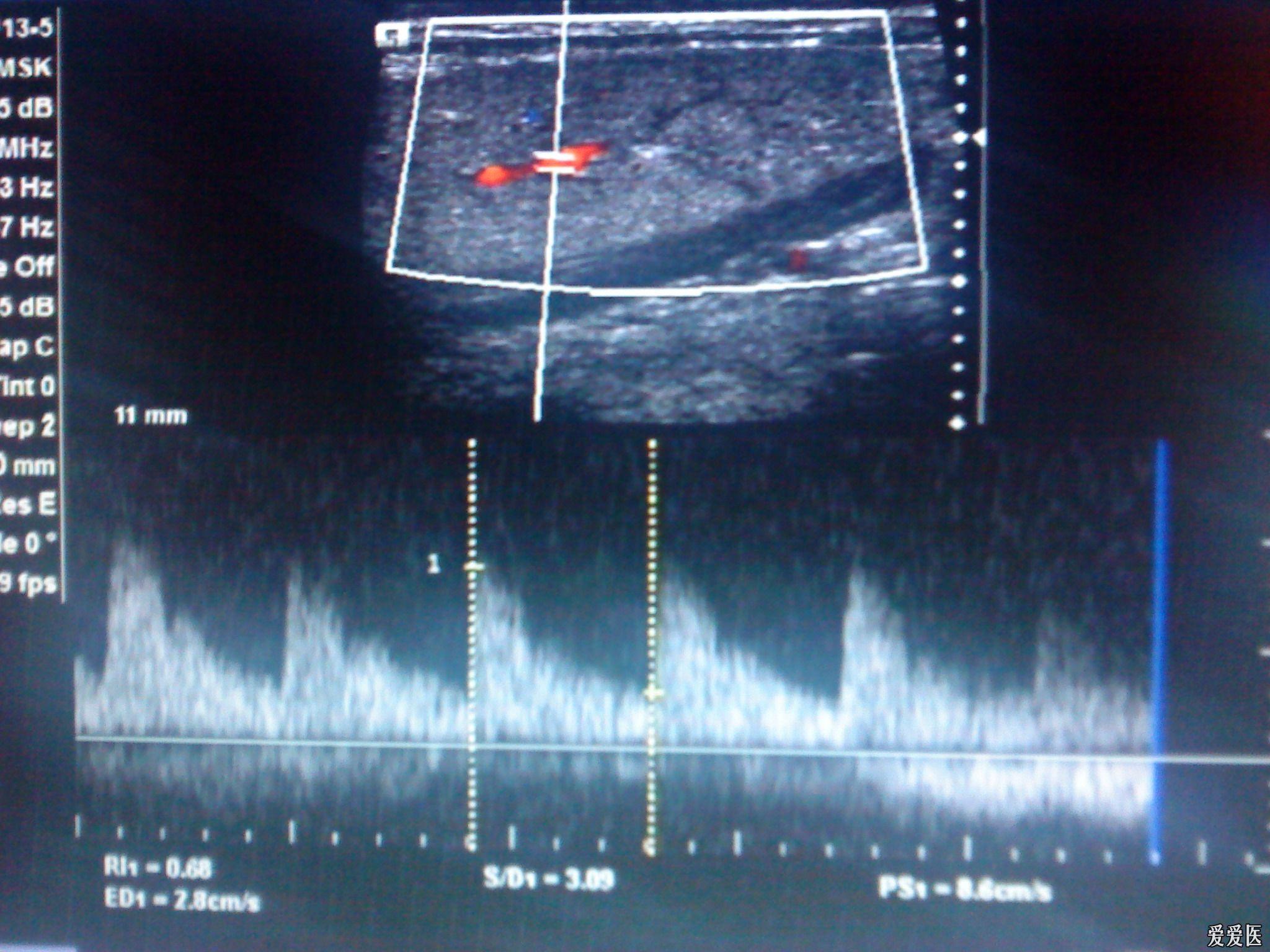 颌下腺炎? - 超声医学讨论版 - 爱爱医医学论坛