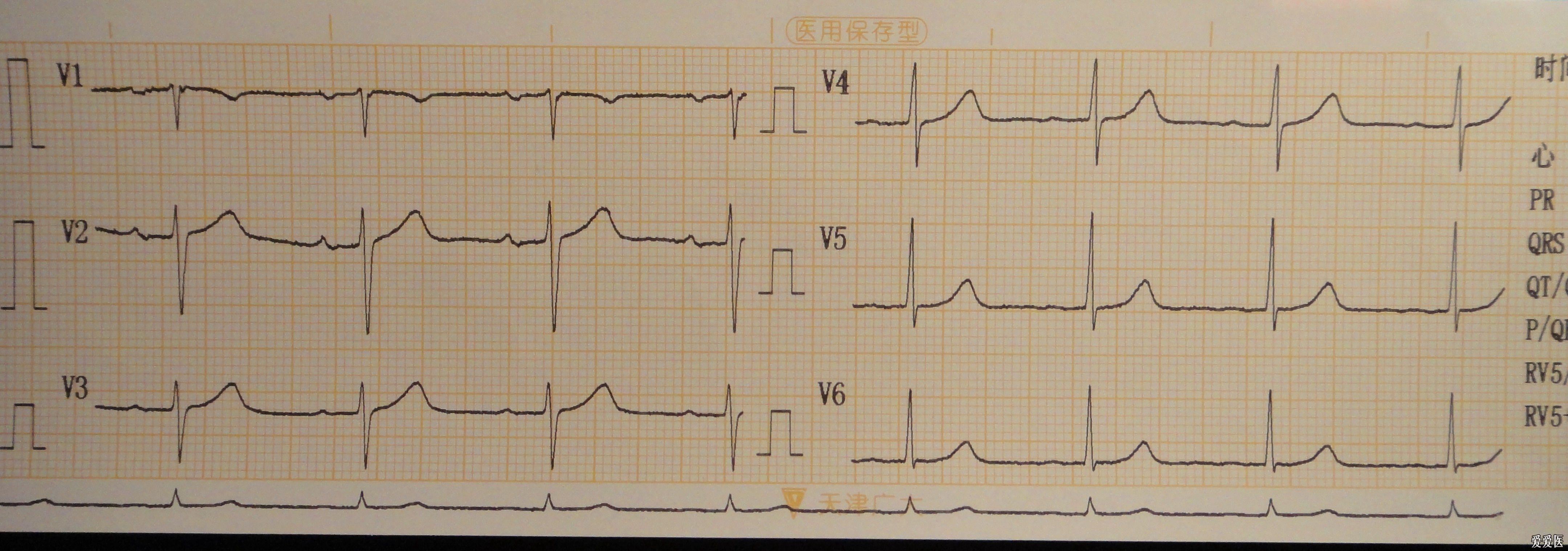 刚作的一个心动过速心电图请老师们指导分析