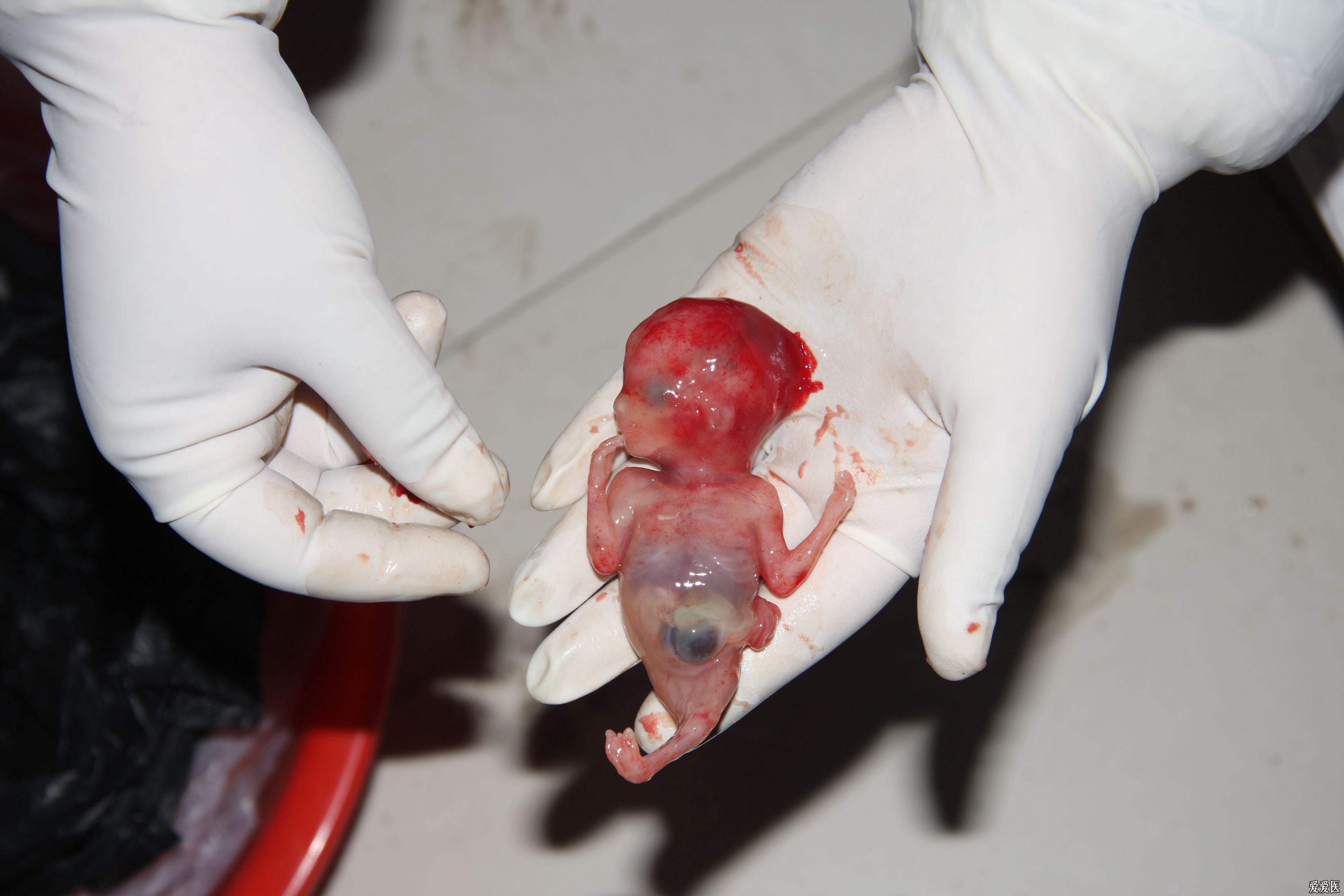 12周引产下来胎儿图图片