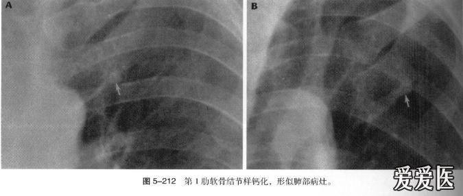 肋骨的正常变异,很容易误诊的