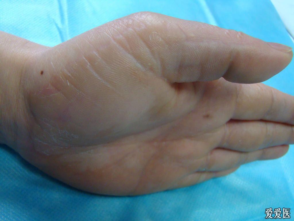 双手掌皮损