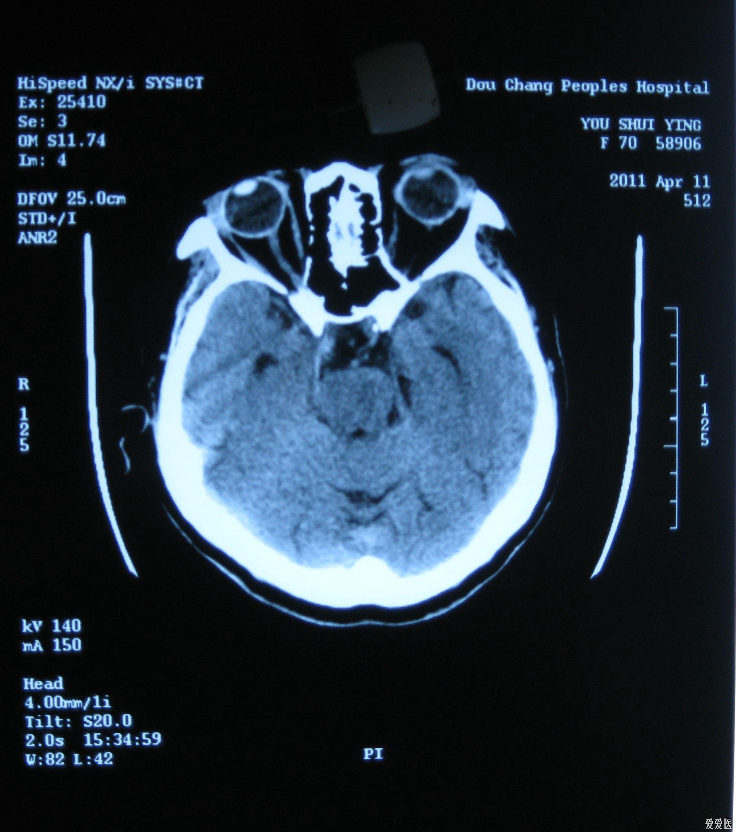 脑CT真实图片