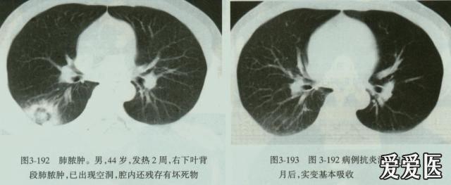 肺脓肿空洞图片