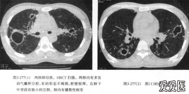 癌性空洞图片