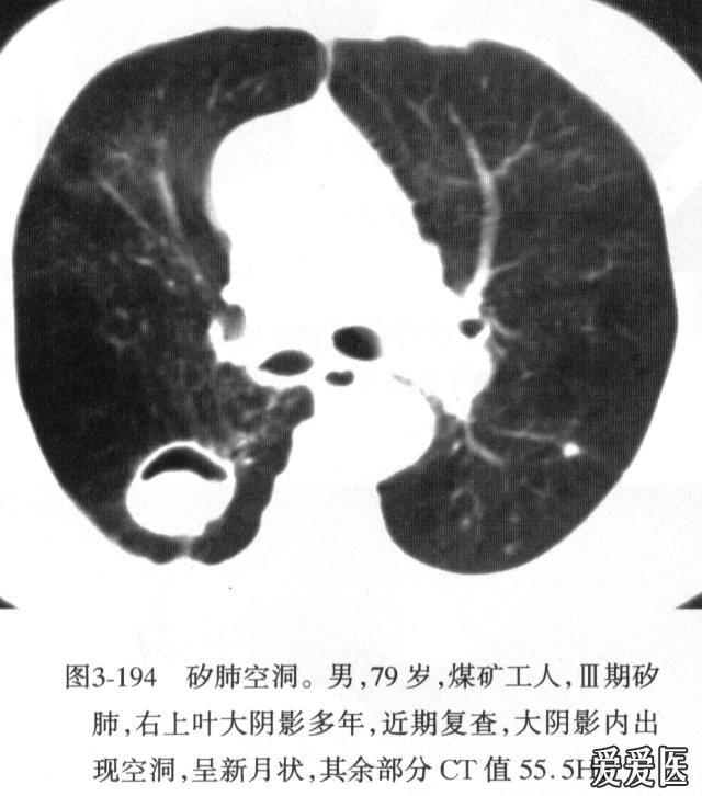 塵肺空洞.jpg