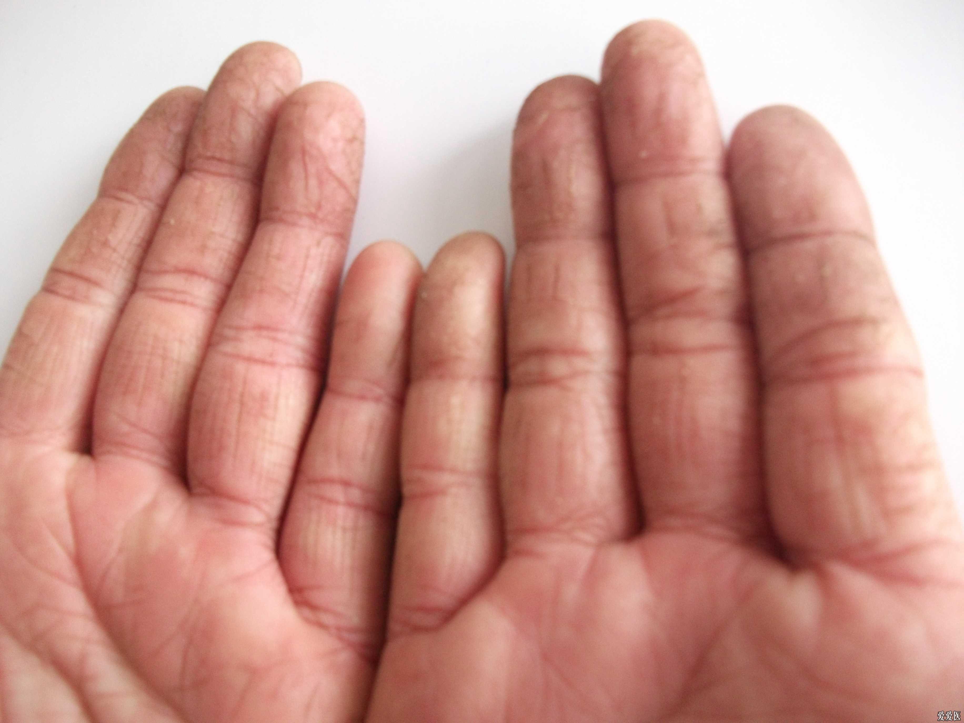 大拇指皲裂性湿疹图片图片
