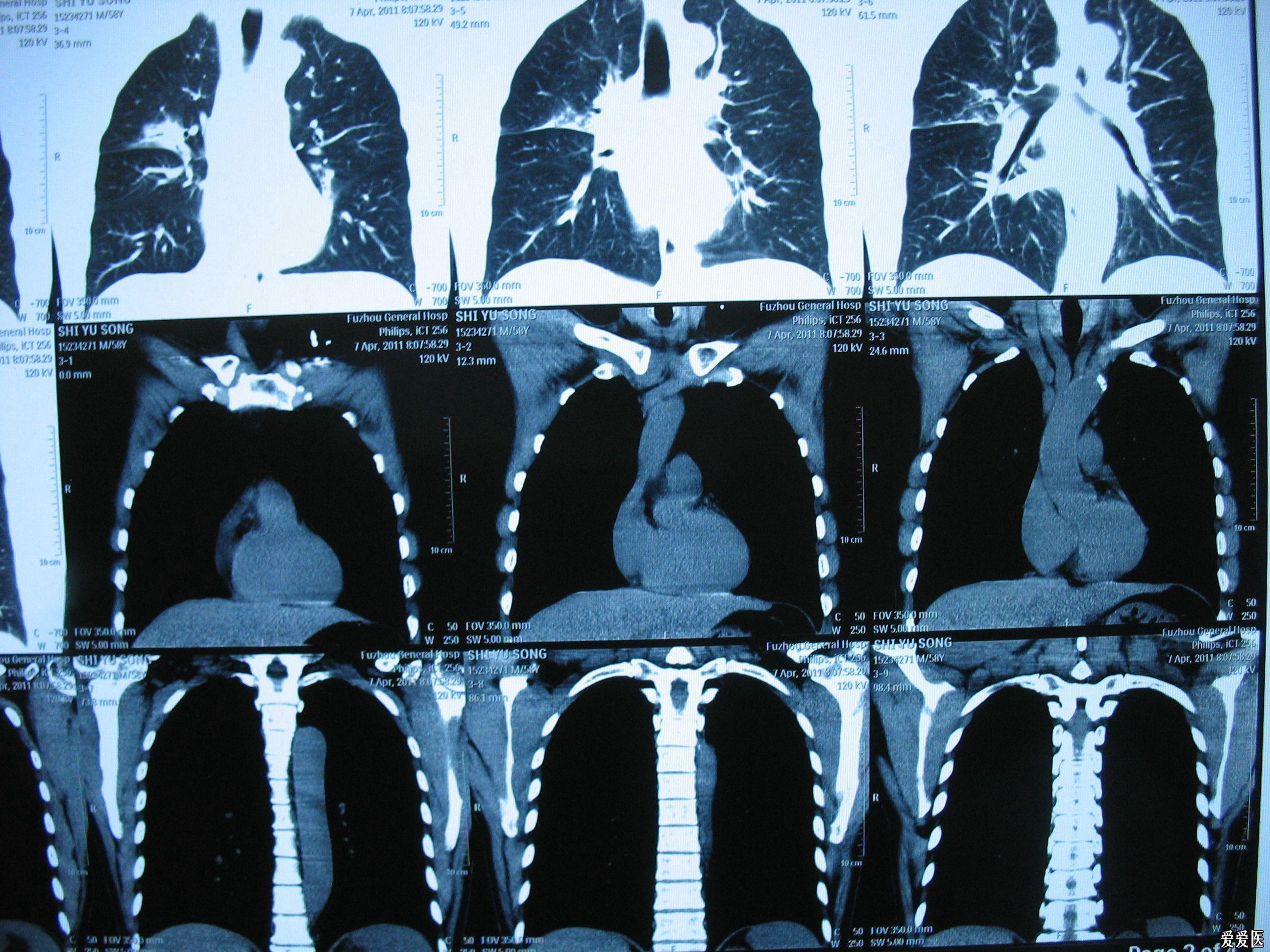 胸部增强ct www.iiyi.com