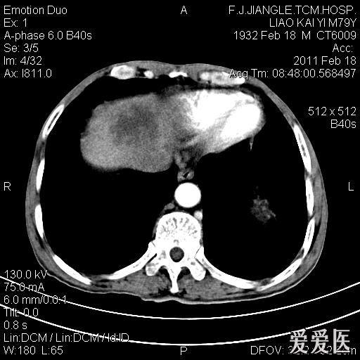 一例确诊的肝脓肿ct平扫增强