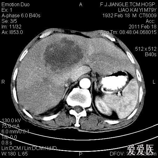 一例确诊的肝脓肿ct平扫增强