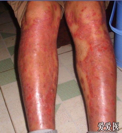 小腿皮肤出现红色斑块图片