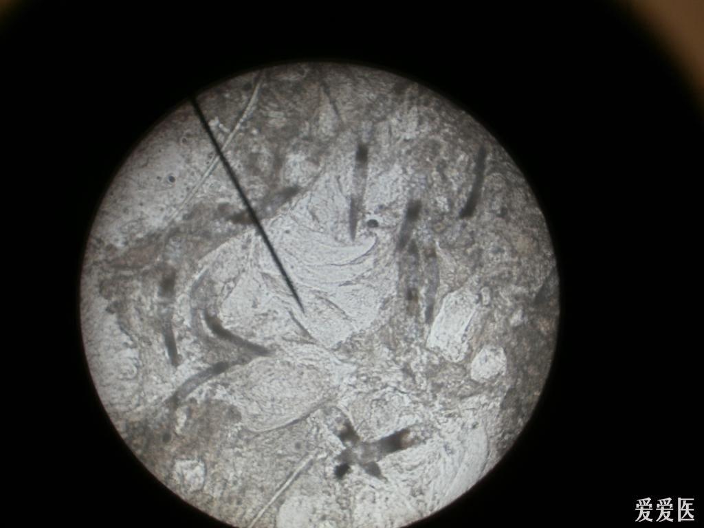 皮肤版u盘奖励典型病例019毛囊螨皮炎