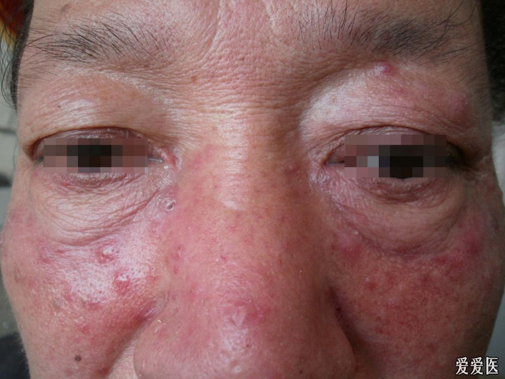 皮肤版u盘奖励典型病例019毛囊螨皮炎