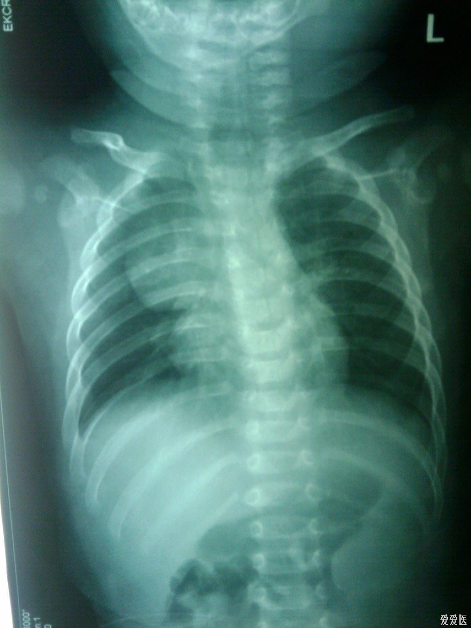小儿支气管肺炎ct图片图片