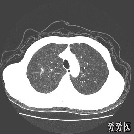 经典肺部病变ct