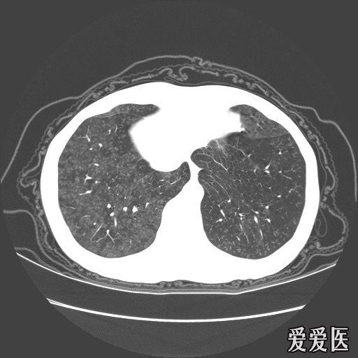 經典肺部病變ct