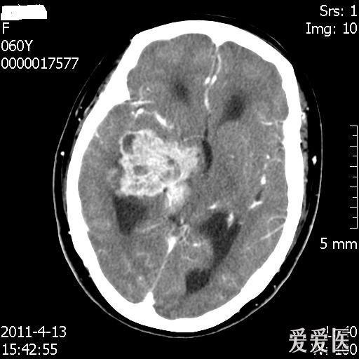 腦瘤的ct病例大家發表下看法