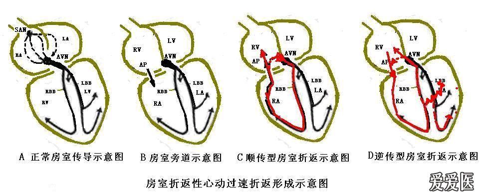 房室结跳动图片