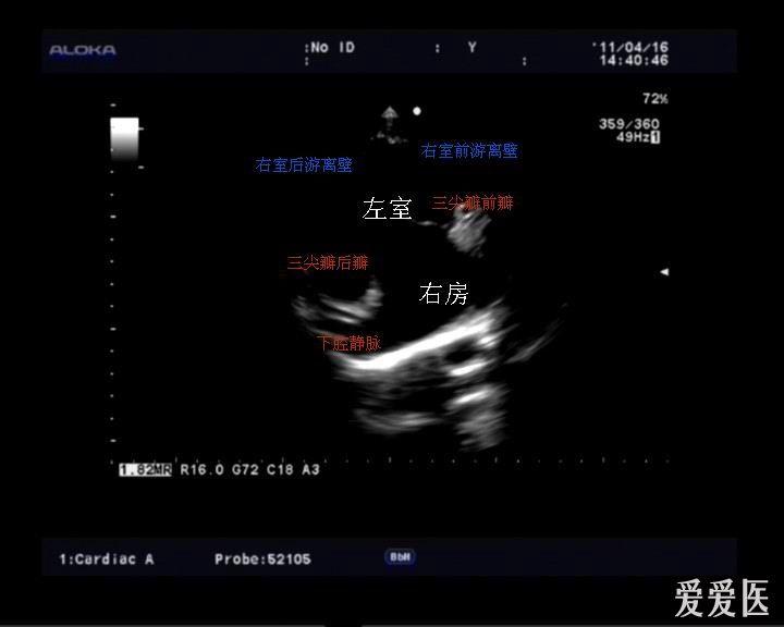 右室流出道切面图片