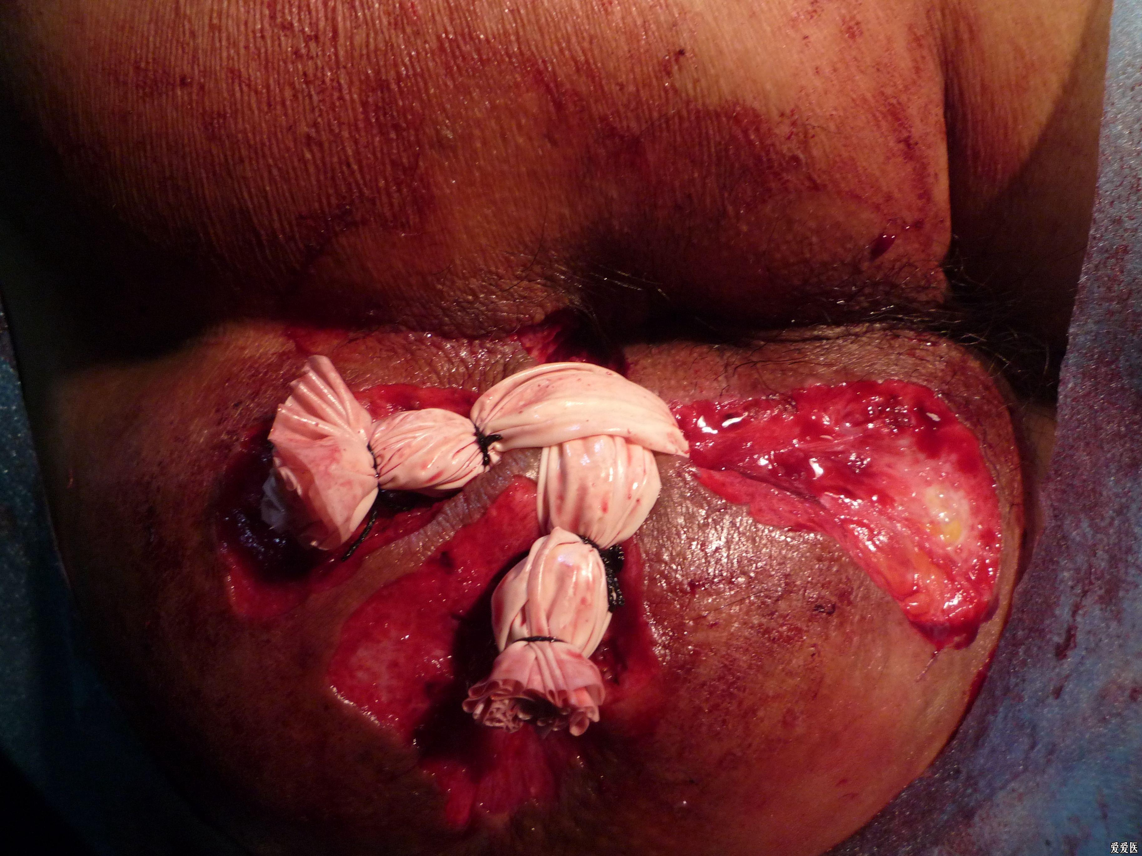 肛瘘术后18天续有图片