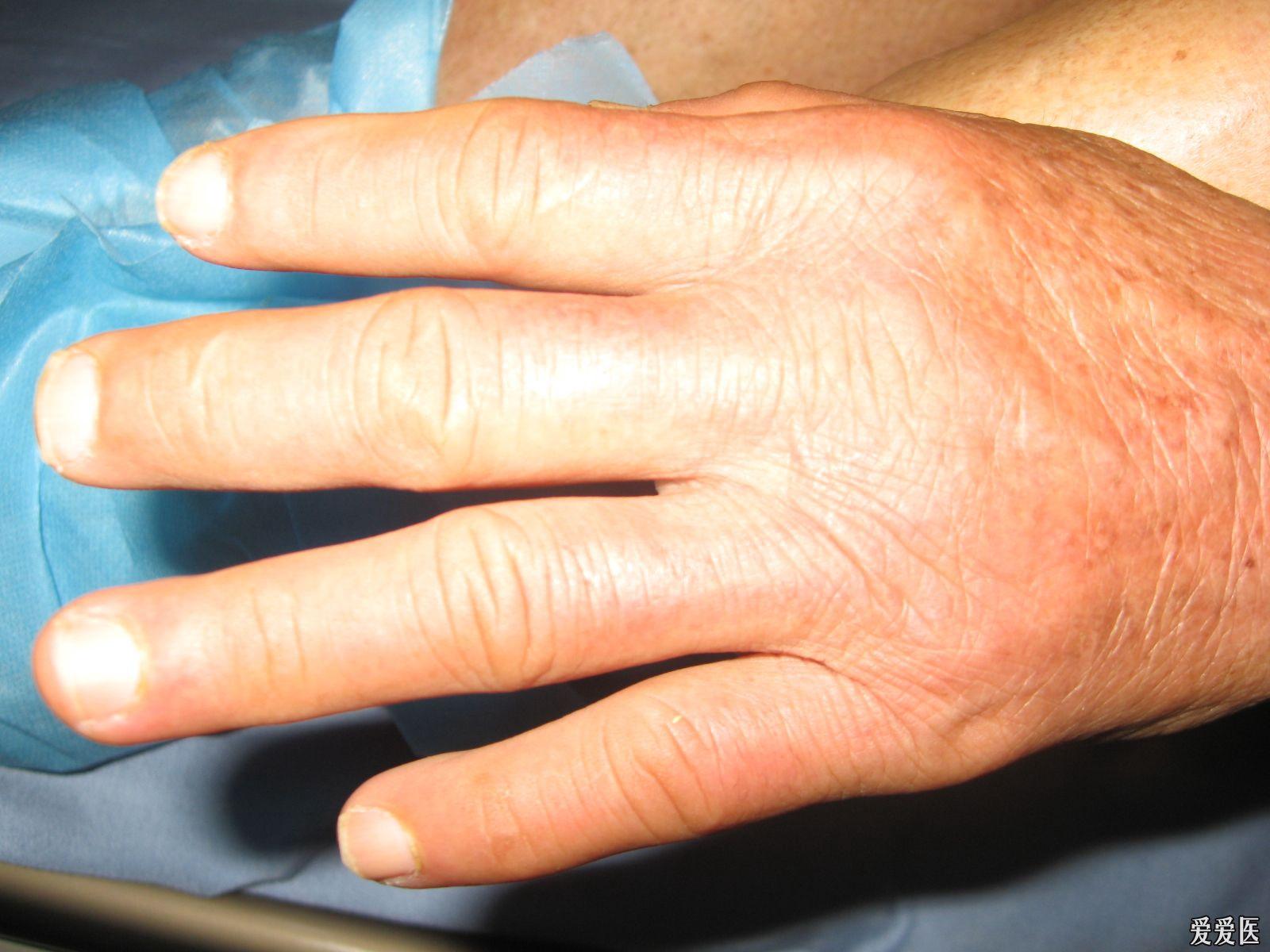 反复的咳嗽三年余,颜面四肢浮肿3月 - 内分泌与代