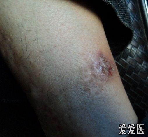 湿疹真菌感染请大家帮忙