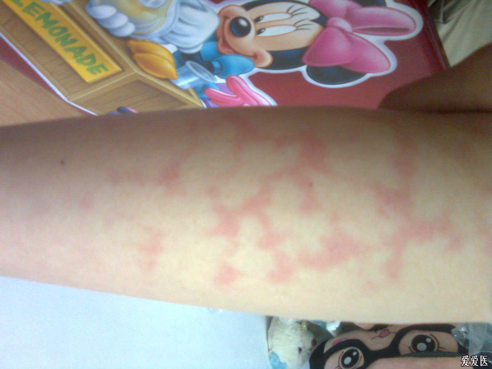 求助 左前臂红***状斑