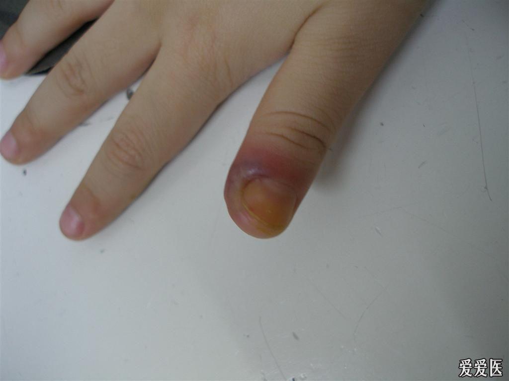手指瘭疽图片
