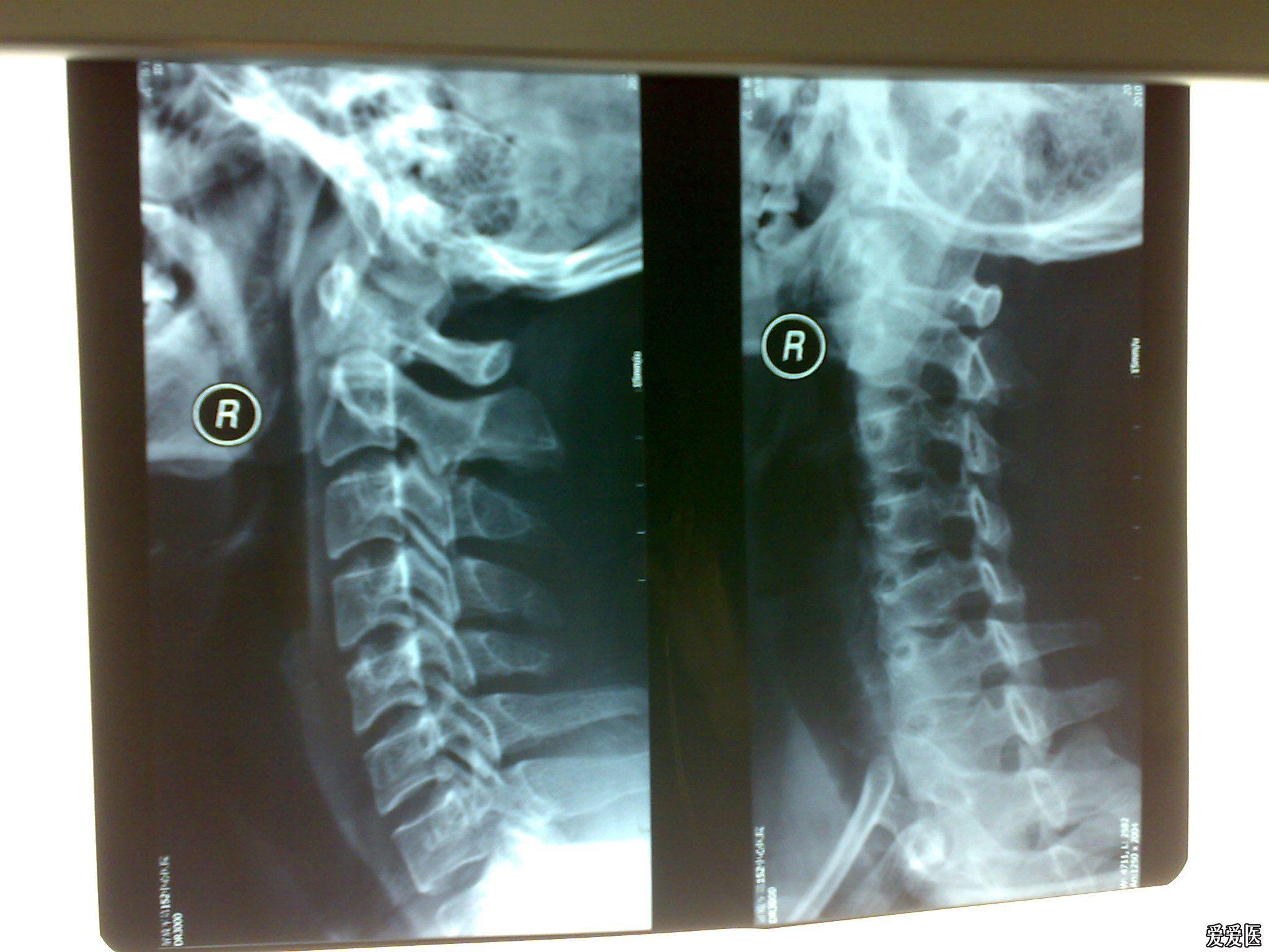 颈椎片子图片