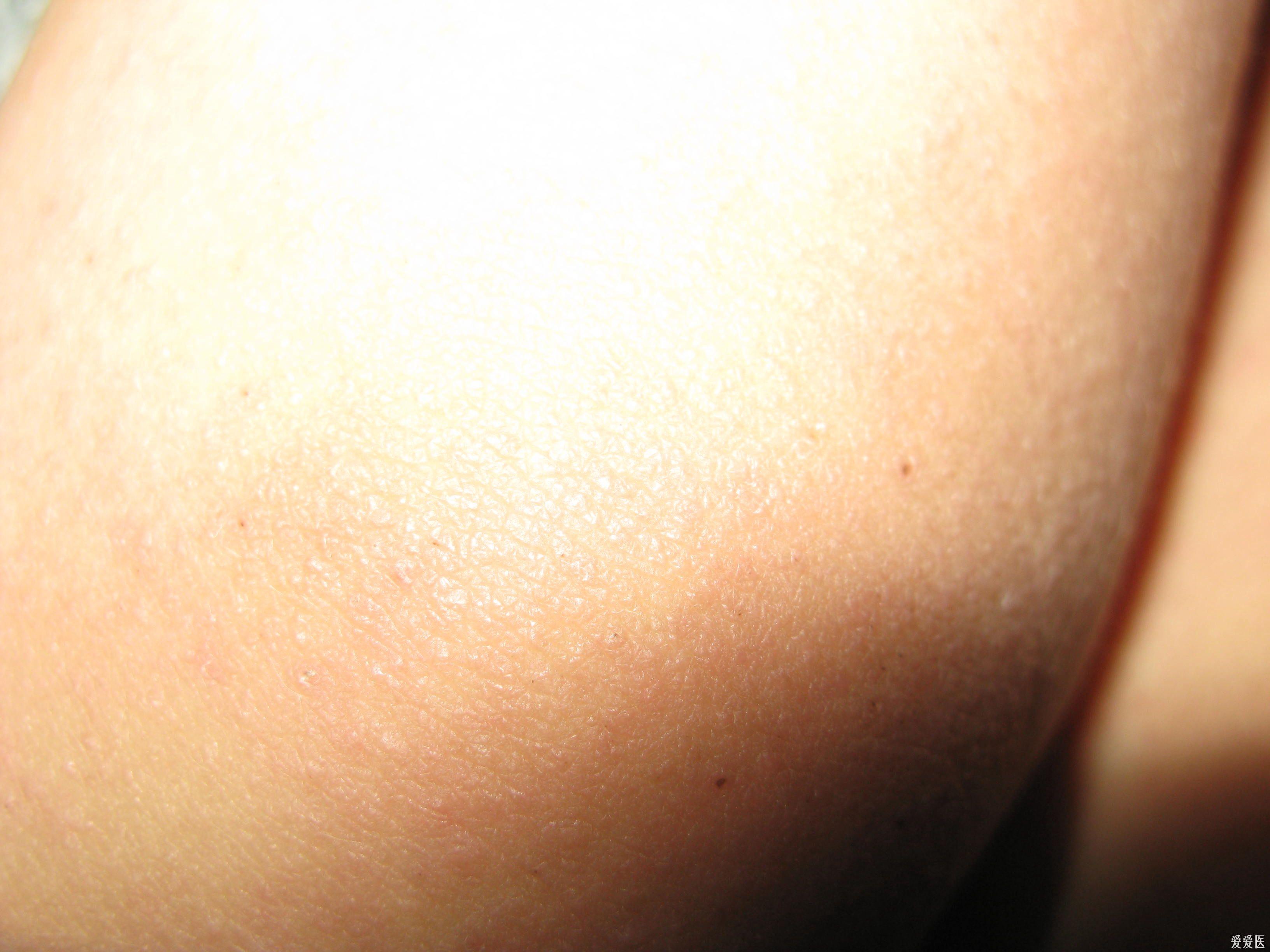 急求助:手足口病后出现新疹子?