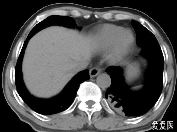 胸部ct,左肺下叶病灶,附增强照片!请指教.