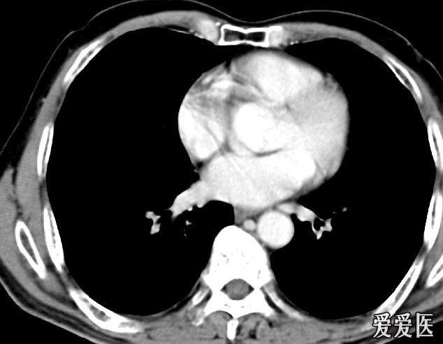 什么情况下需要做增强ct 1104242105fe35b0c57e59f2c8.jpg