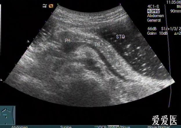 环状胰腺超声图像图片