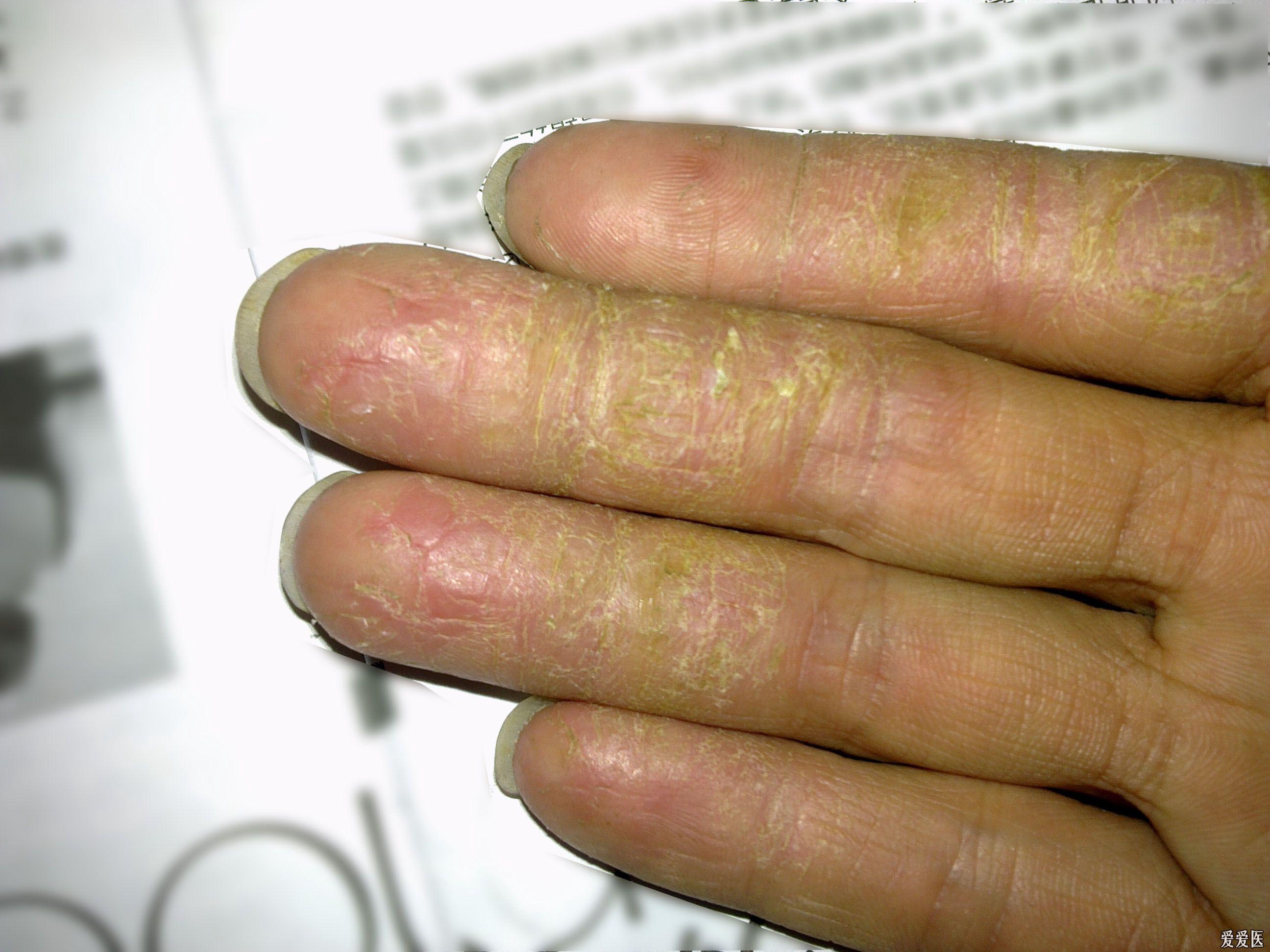 链球菌感染手脱皮图图片