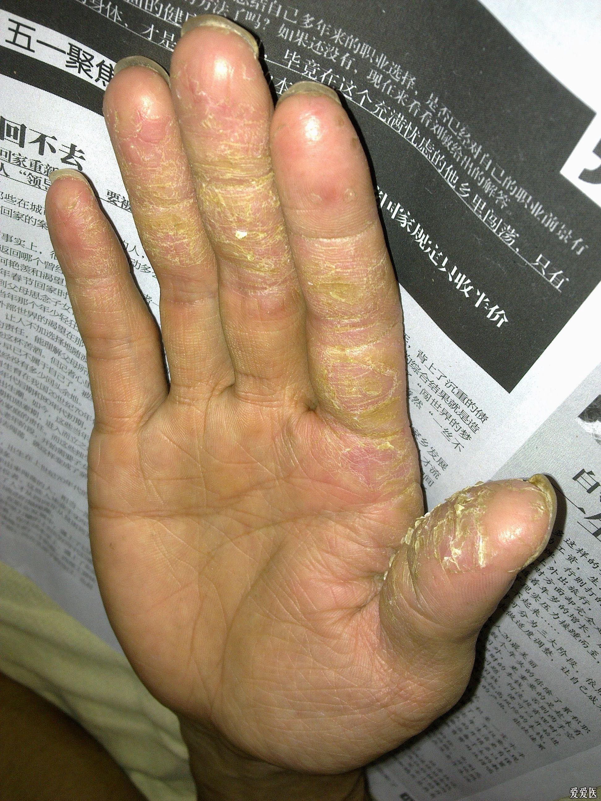 链球菌感染手脱皮图图片