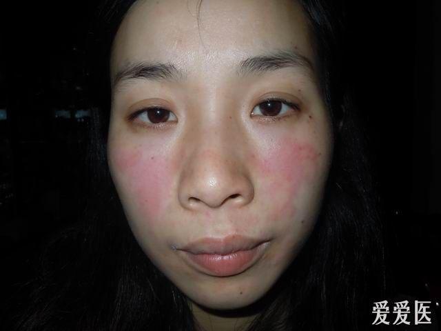 拜托皮肤科的同行帮忙看一些这个病例有可能是红斑狼疮吗