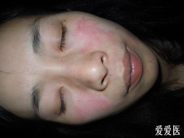 拜托皮肤科的同行帮忙看一些这个病例有可能是红斑狼疮吗