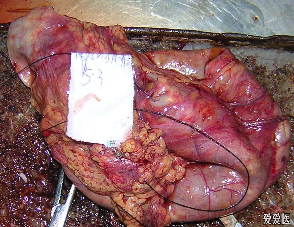结肠癌腹部包块图片