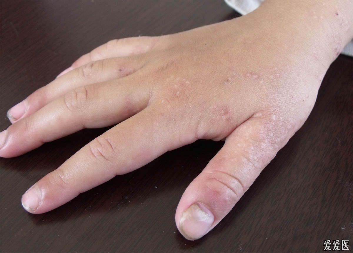 看小孩手上什么病