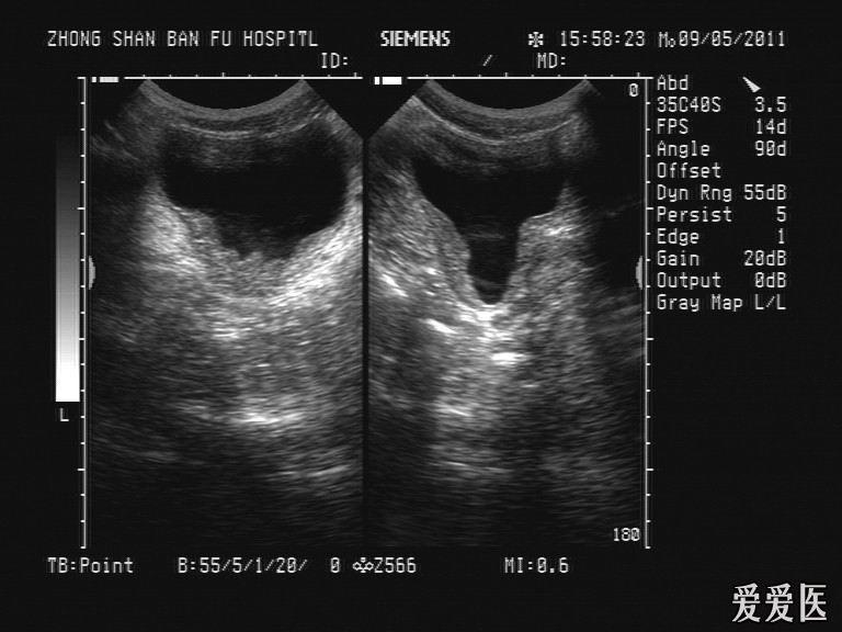 请问是腺性膀胱炎吗 - 超声医学讨论版 - 爱爱医医学论坛