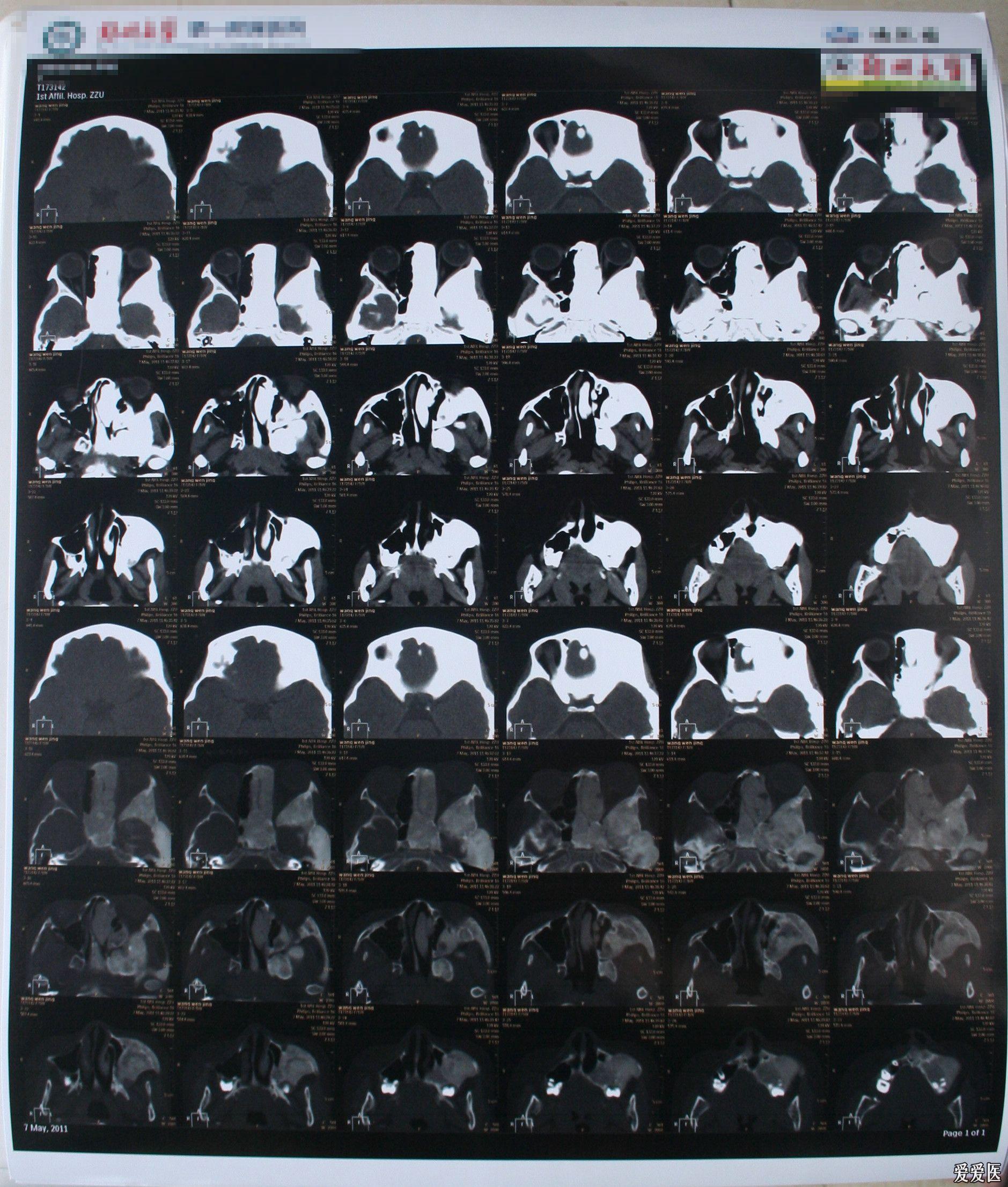 12岁女孩得了骨纤怎么治疗?