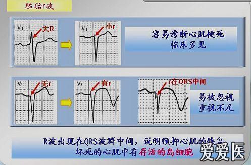 什么是碎裂的qrs波