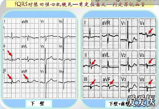 什么是碎裂的qrs波