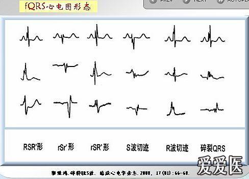 心电图qrs波图解图片