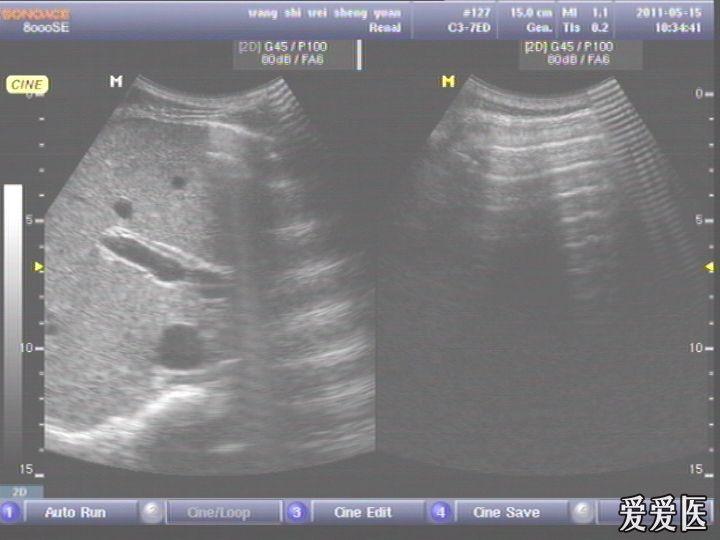 胃穿孔彩超图片图片
